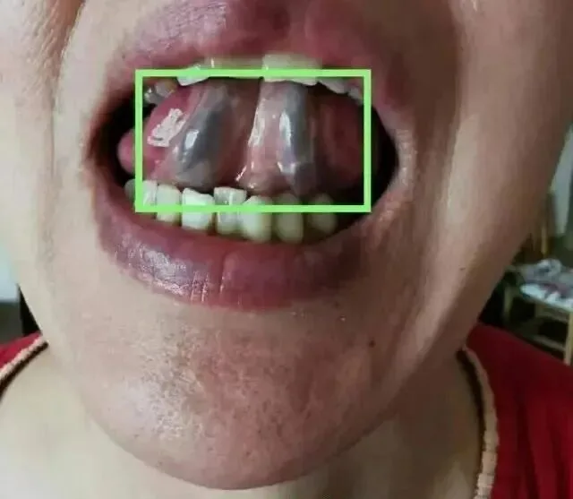 这味药，专治重病、大病、难病，破血逐瘀能力很强！用它治疗脑动脉瘤，效果很好