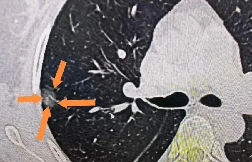 这3个指标，决定肺结节会不会变成肺癌！自己就能判断危险等级